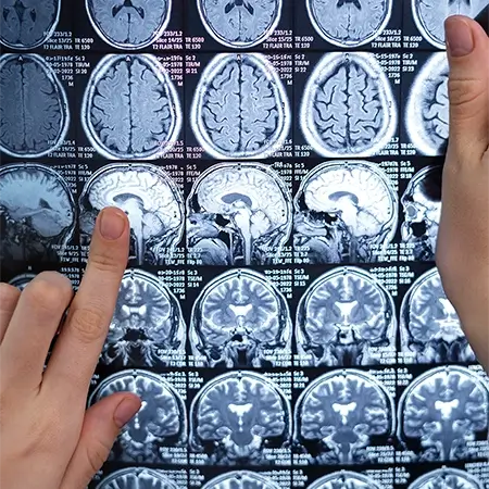 imagem de um exame neurológico com vários representações gráficas do cérebro, com os dedos de um profissional apontando para eles